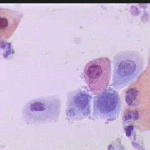 Παραβασικά κυτταρα με διογκωμενους ανισομεγέθεις πυρήνες. Καθαρό υπόστρωμα
